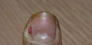 Как лечить нагноение возле ногтя
