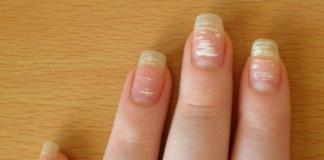 Что означают белые пятна на ногтях по приметам Белое пятнышко на ногте пальца руки